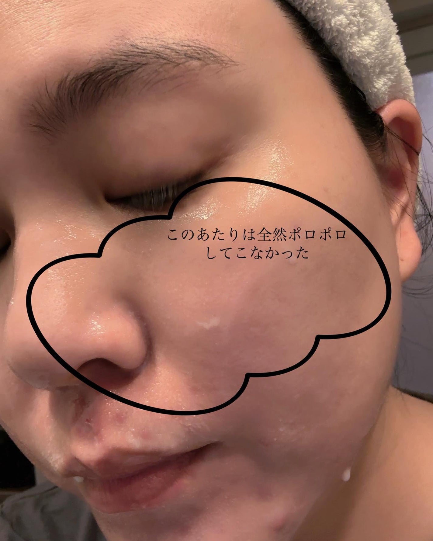 薬用アクネ角質ケアジェル/NIKI PITA/ピーリングを使ったクチコミ(5枚目)