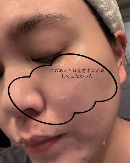 薬用アクネ角質ケアジェル/NIKI PITA/ピーリングを使ったクチコミ(5枚目)