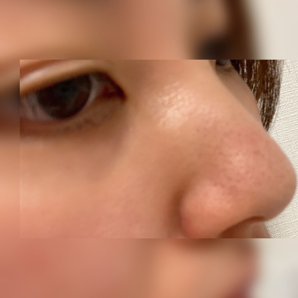 さと on LIPS 「DUO2ヶ月目!本音レビュー🗣⚠️2枚目は実際に毛穴の写真です..」(2枚目)