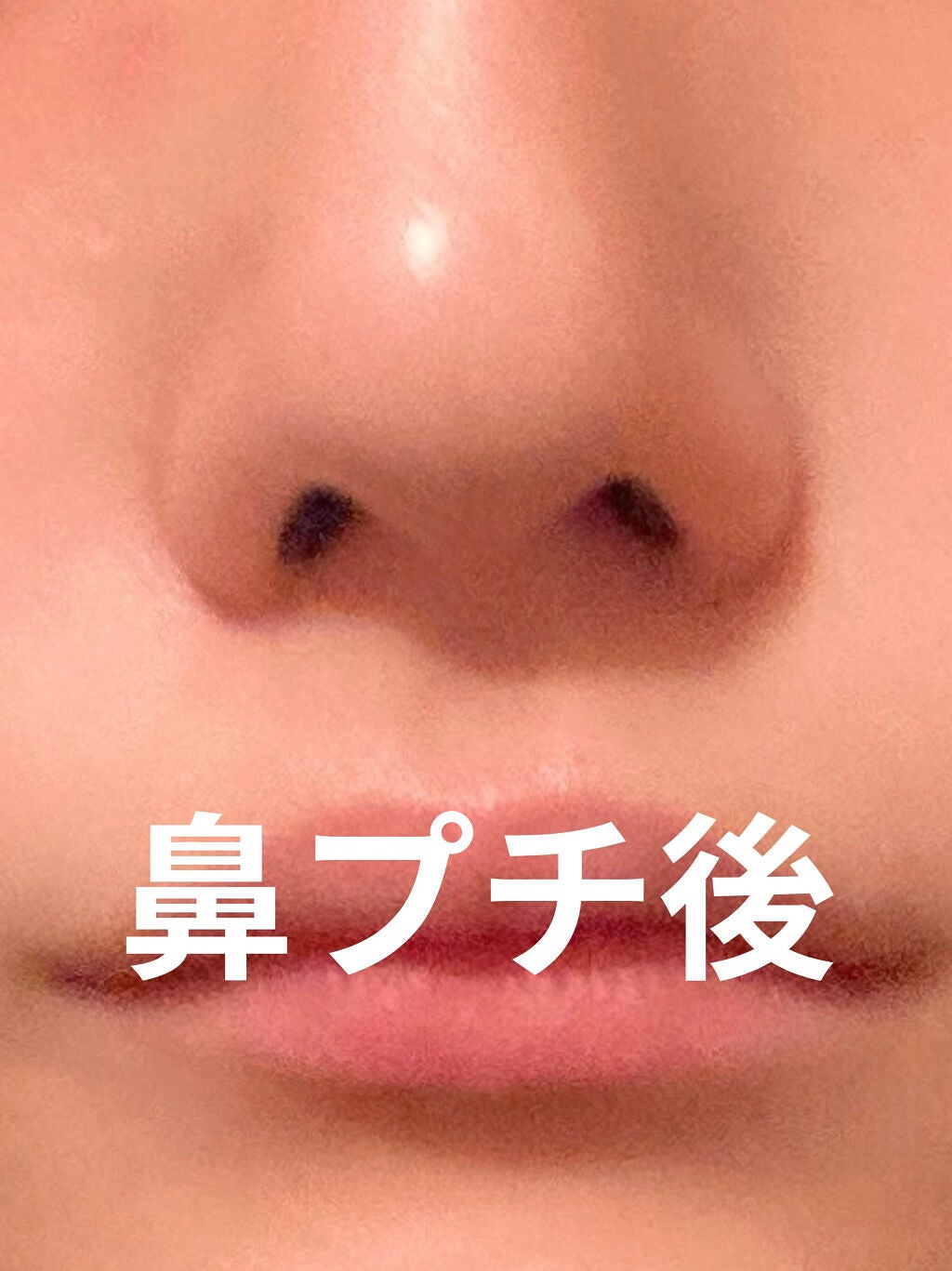 みんみみ on LIPS 「⚠️鼻の写真が写ります。 苦手な方は閲覧をお控えください。初め..」(4枚目)