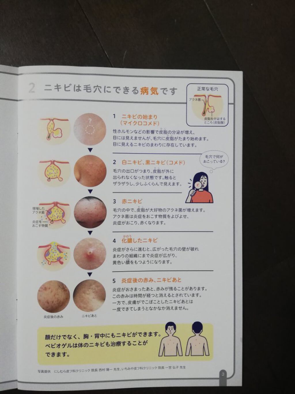 RI♡ on LIPS 「ベピオゲル医薬品ニキビが酷いから皮膚科へ赤みは少なくなったけど..」(4枚目)