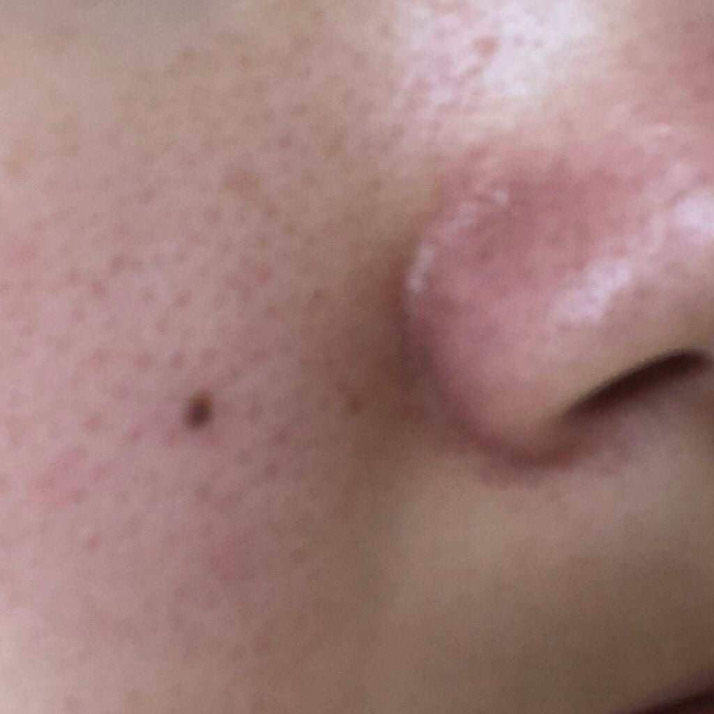 Shurn______% on LIPS 「毛穴ってどうすれば治りますか?開き毛穴すぎて改善策がみあたりま..」(1枚目)