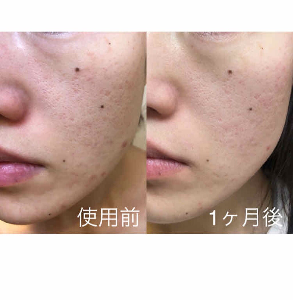 薬用ベビーパウダー/ピジョン/ボディパウダーを使ったクチコミ(2枚目)