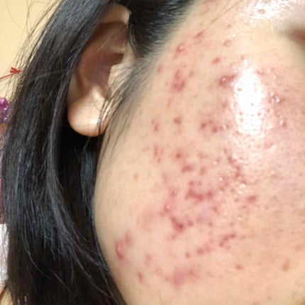 エピデュオゲル/マルホ株式会社/その他を使ったクチコミ(2枚目)