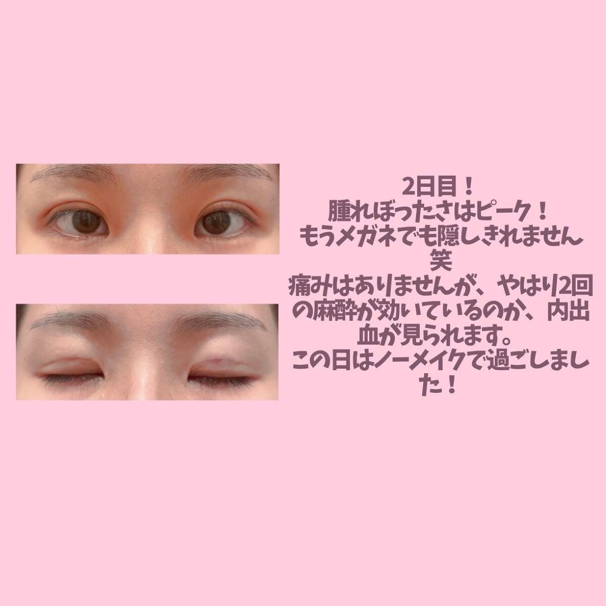 ししっぴ。フォロバはお任せください💕 on LIPS 「二重埋没ダウンタイム途中経過🙌💕こんにちは!ししっぴ。です!初..」(3枚目)