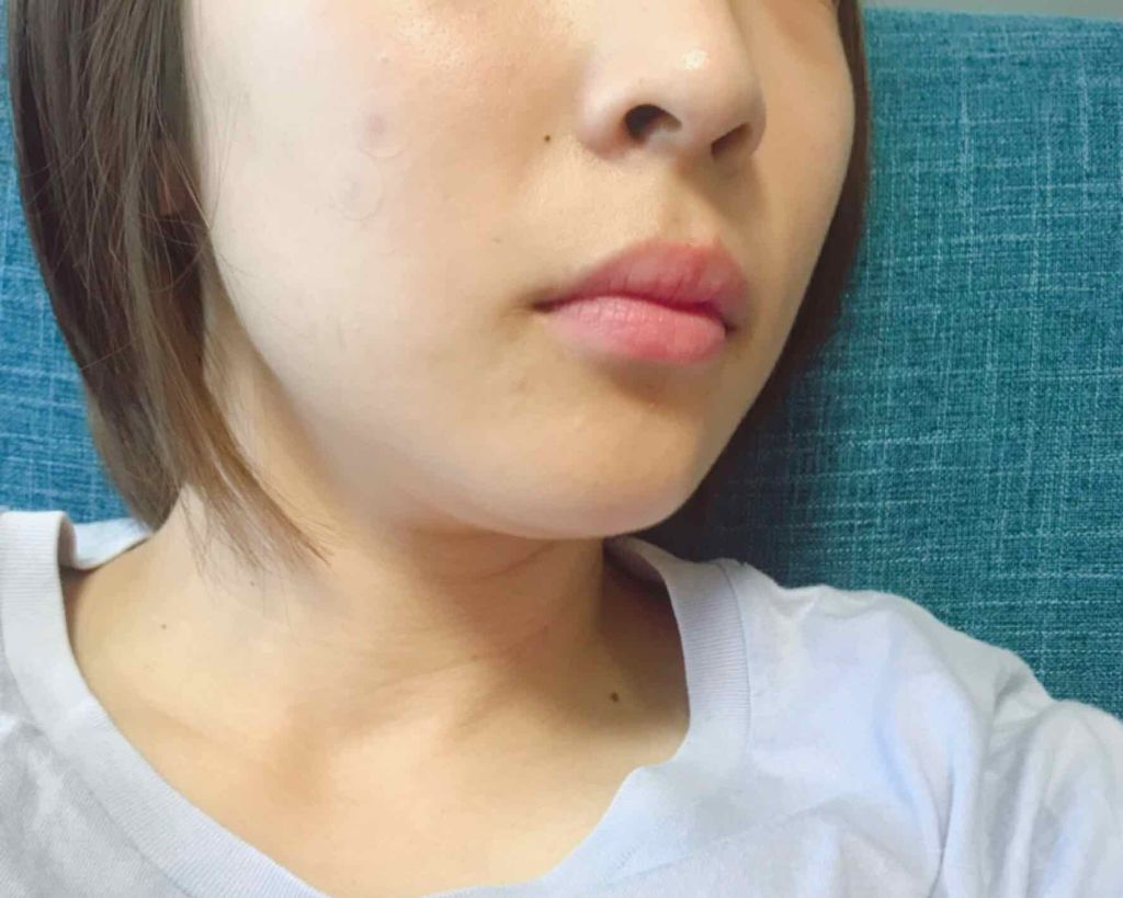 AC SOLUTION CLEAR SPOT PATCH/G9SKIN/にきびパッチを使ったクチコミ（3枚目）