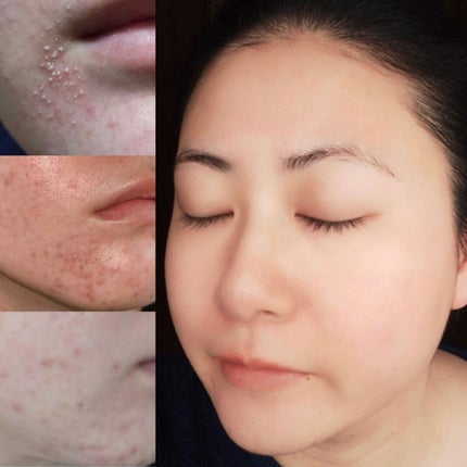 敏感肌な研究者💊あすか💊 on LIPS 「今回は#ダイエットがはからずも#ニキビケアになった経緯を、詳細..」(8枚目)