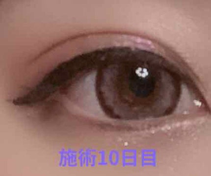 asir on LIPS 「二重整形 埋没(2点留め)10/3整形しました!⚠️写真注意で..」(1枚目)