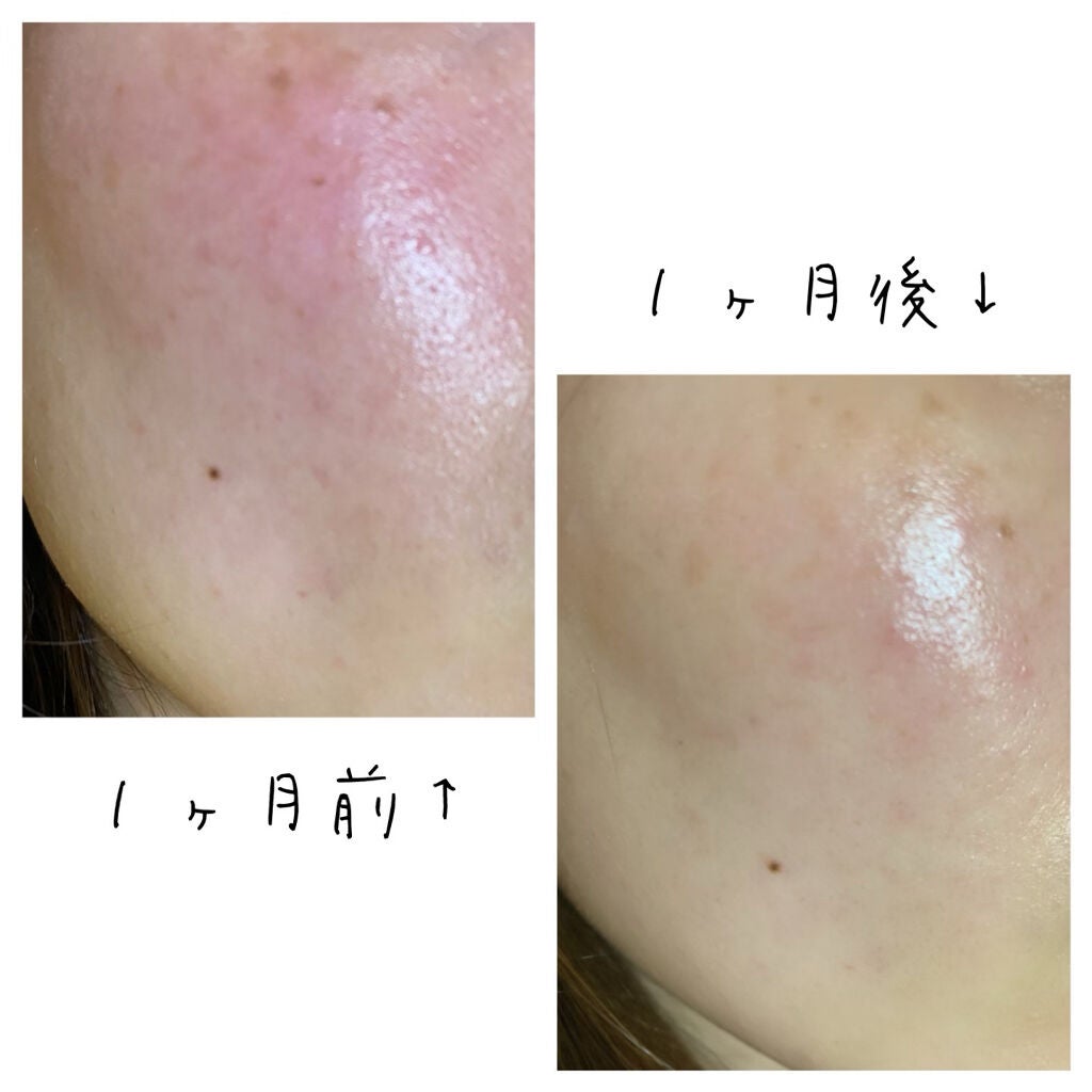 ホワイトCクリア(医薬品)/トランシーノ/その他を使ったクチコミ(3枚目)