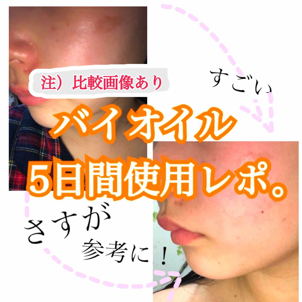 バイオイル/バイオイル/フェイスオイルを使ったクチコミ（1枚目）