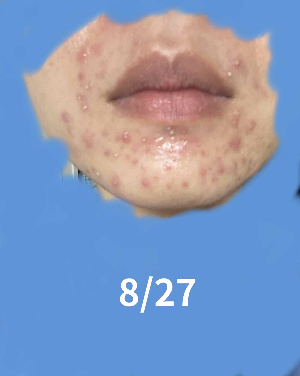 試してみた ドルマイコーチ軟膏 医薬品 ゼリア新薬工業 Lips