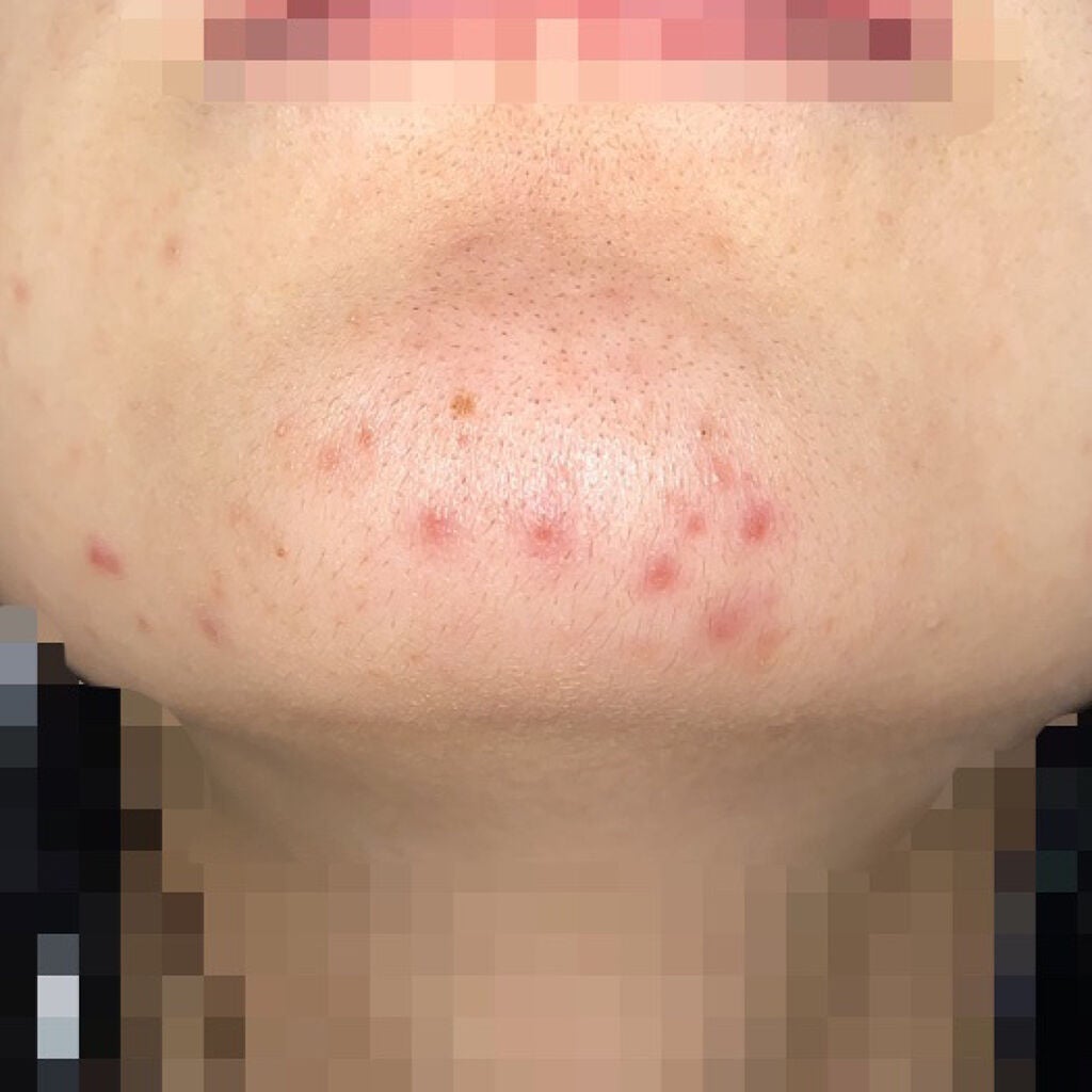 オキシドール(医薬品)/日本薬局方/その他を使ったクチコミ(4枚目)