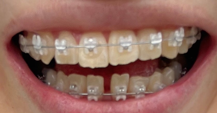 ハナ on LIPS 「矯正6回目(ワイヤー3回目)変化あんまりないかも??奥歯にもブ..」(3枚目)