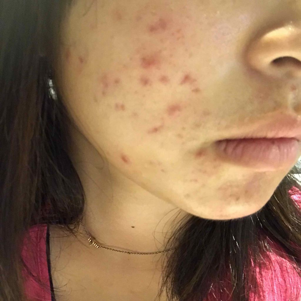 ポム on LIPS 「レーザー治療をしたので明日からまたひどくなるなぁ😂😂根気強く頑..」(3枚目)