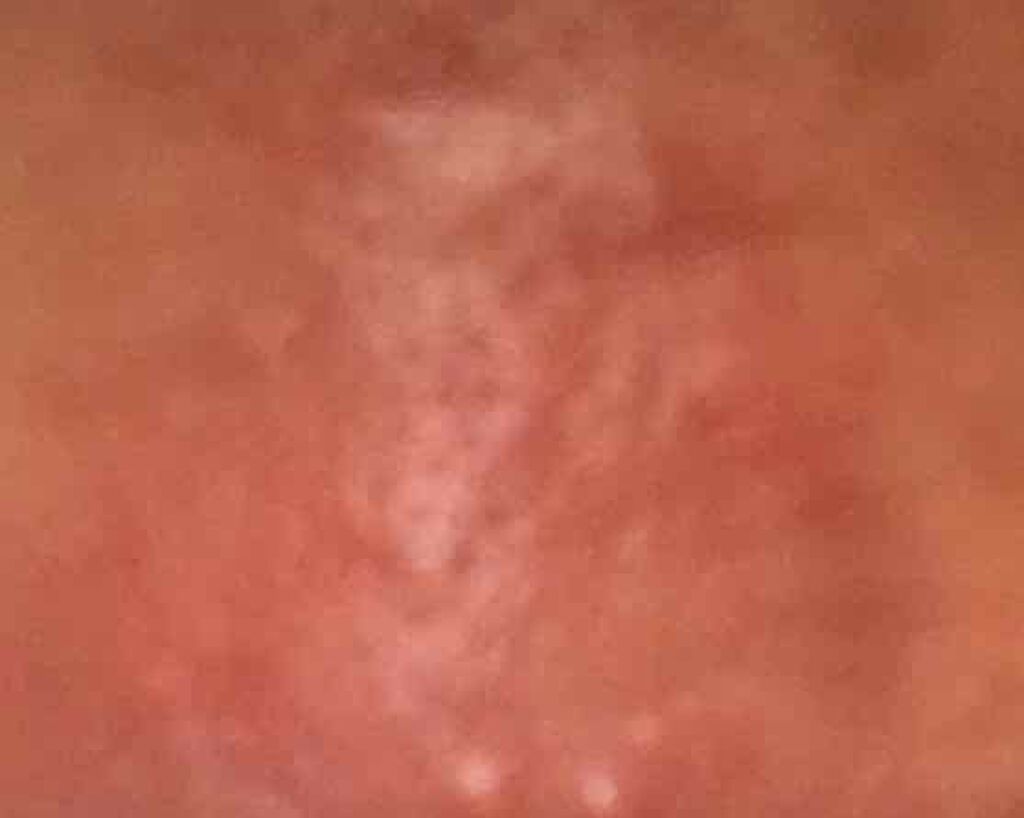 twinkle_lips_c6o on LIPS 「2月23日ニキビ跡になってしまいなかなか治らない、花粉もあって..」(3枚目)