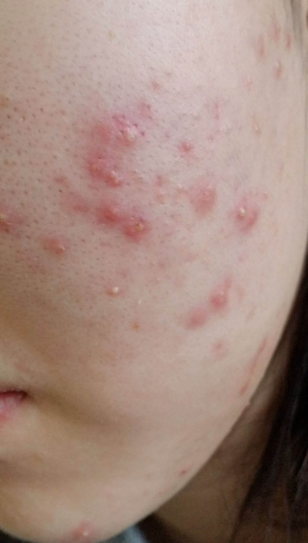 A アクネフォーム/NOV/洗顔フォームを使ったクチコミ（2枚目）