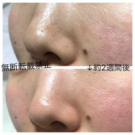 エマルジョンリムーバー 300ml/200ml/水橋保寿堂製薬/その他洗顔料を使ったクチコミ(2枚目)