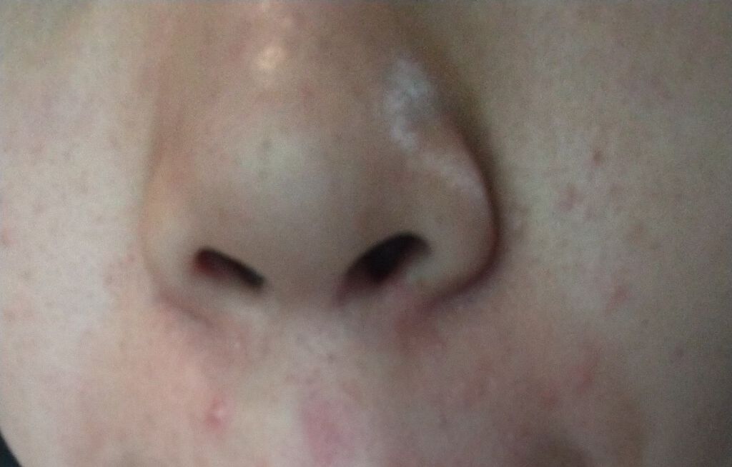 ちゅけまる on LIPS 「画像汚くてごめんなさい💦ニキビに4年間悩んでいます。どうしたら..」(1枚目)