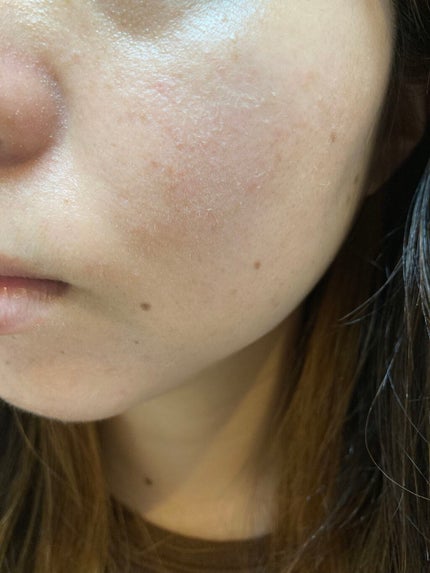 しい on LIPS 「カソーダ19日目昨日投稿し忘れた分です。皮むけがいっきに起こり..」(2枚目)