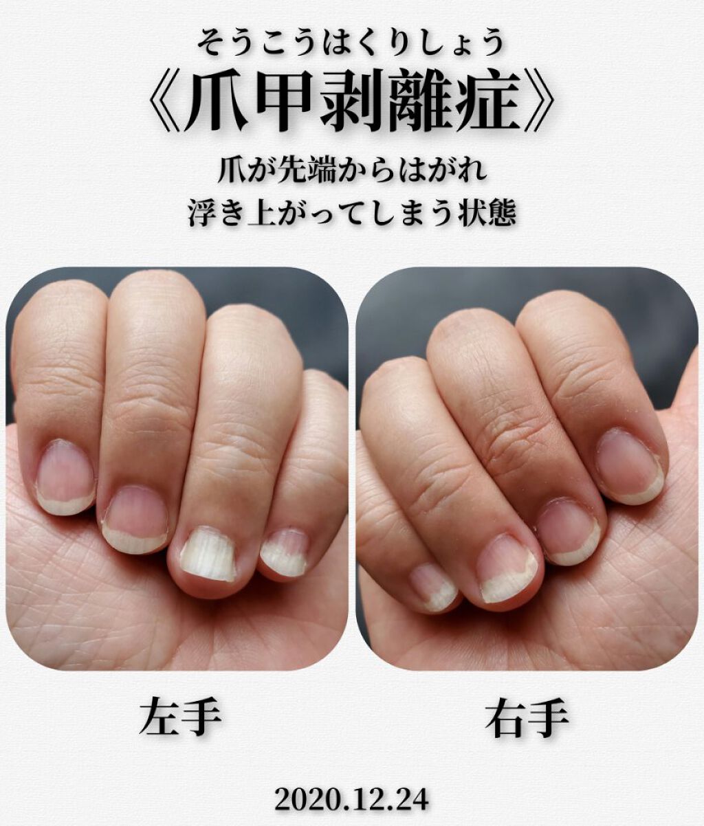 クイックケアコート Ettusaisを使った口コミ お見苦しい画像があります 重度の爪甲剥離 By かぴめろん 気力ダウン 乾燥肌 40代後半 Lips