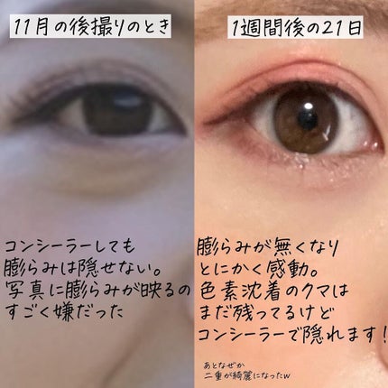 m♡ on LIPS 「念願の、目の下の脱脂をしてきました!!!!1ヶ月経ったらレポし..」(6枚目)