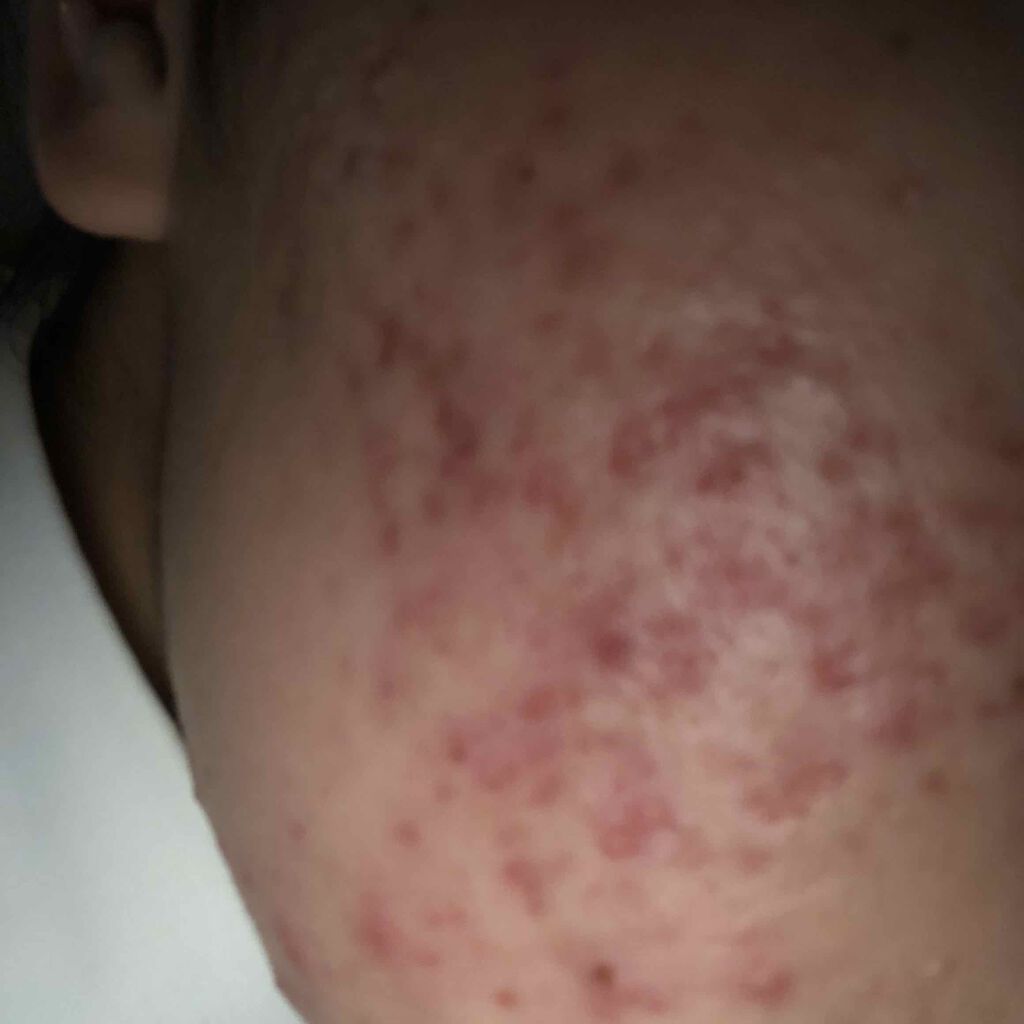 まいまい on LIPS 「初めての投稿です。私はいまひどいニキビで悩んでいます。ココ最近..」(4枚目)