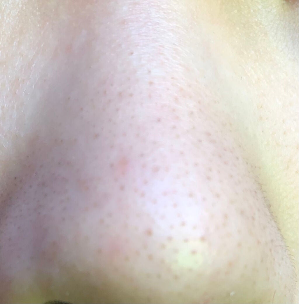 女子力低めのさくらんぼ on LIPS 「皆さん助けてー何しても治らない黒ずみ毛穴治す方法を教えて下さい..」(2枚目)