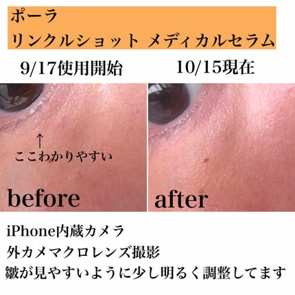 リンクルショット メディカル セラム/リンクルショット/アイケア・アイクリームを使ったクチコミ(2枚目)