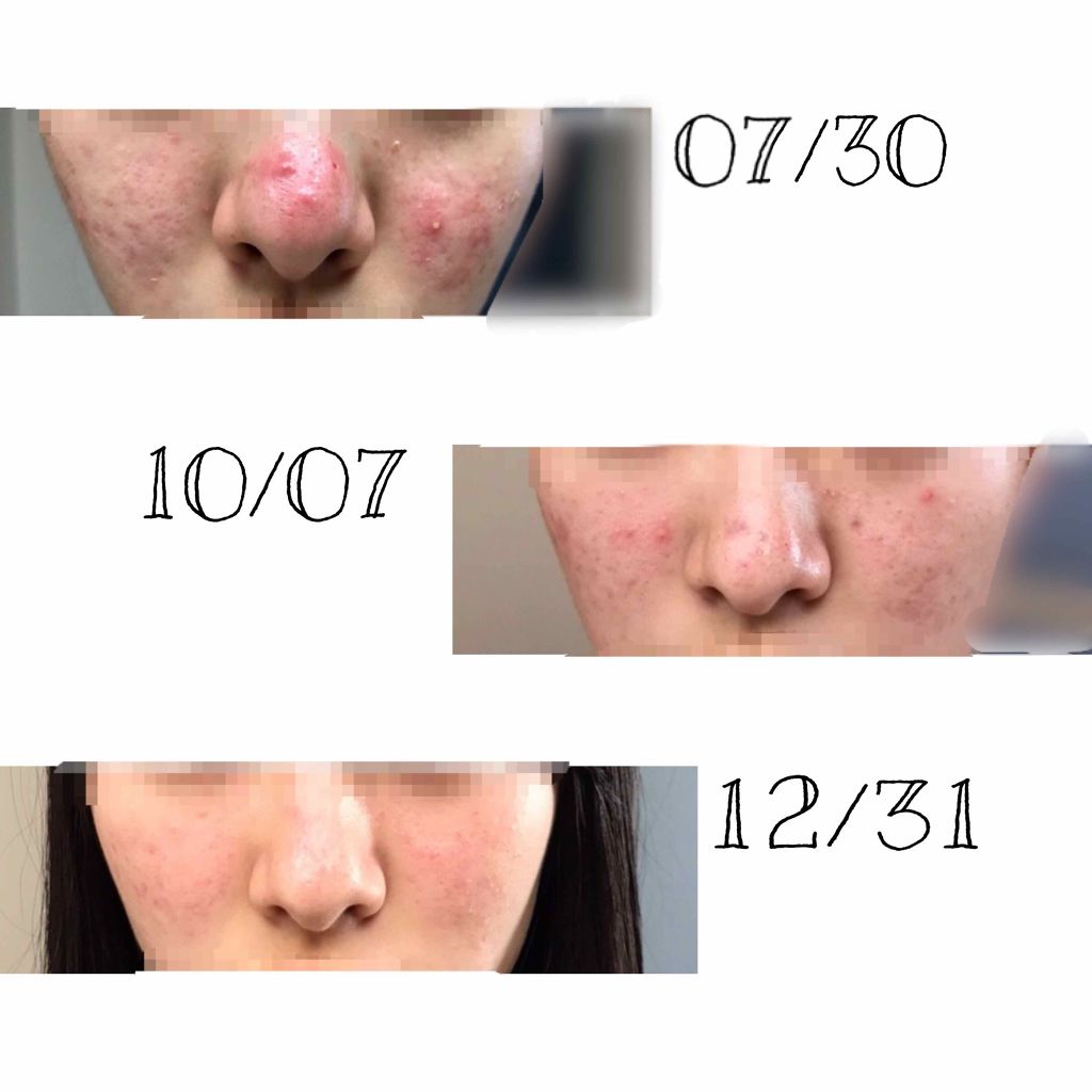 ハトムギ化粧水(ナチュリエ スキンコンディショナー R )/ナチュリエ/化粧水を使ったクチコミ(2枚目)