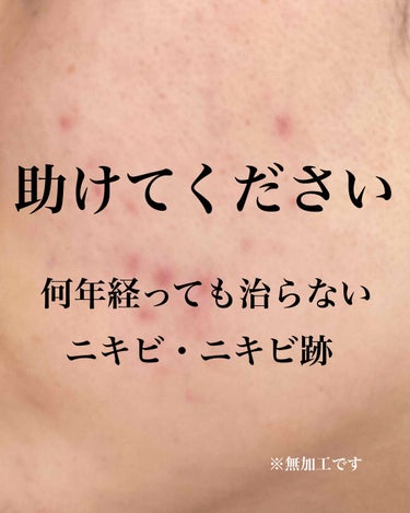 無印良品 敏感肌用薬用美白美容液のクチコミ「初めまして😌さい といいます。

私は小2からずっとニキビがあって治りません。
小さい頃は主に.....」（1枚目）