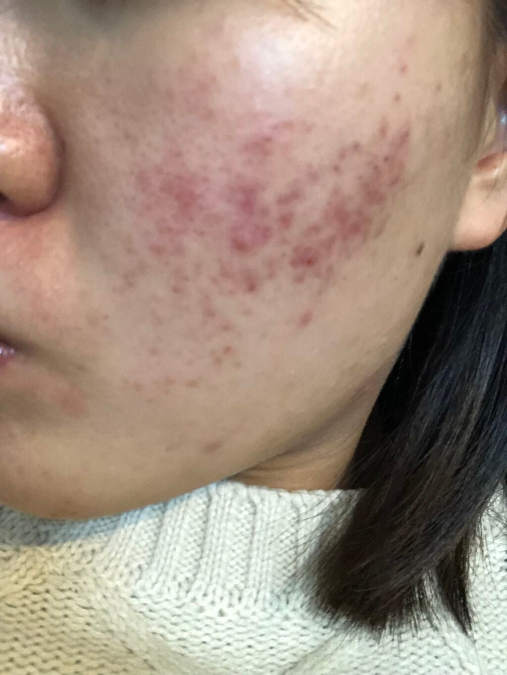 A アクネフォーム/NOV/洗顔フォームを使ったクチコミ(3枚目)