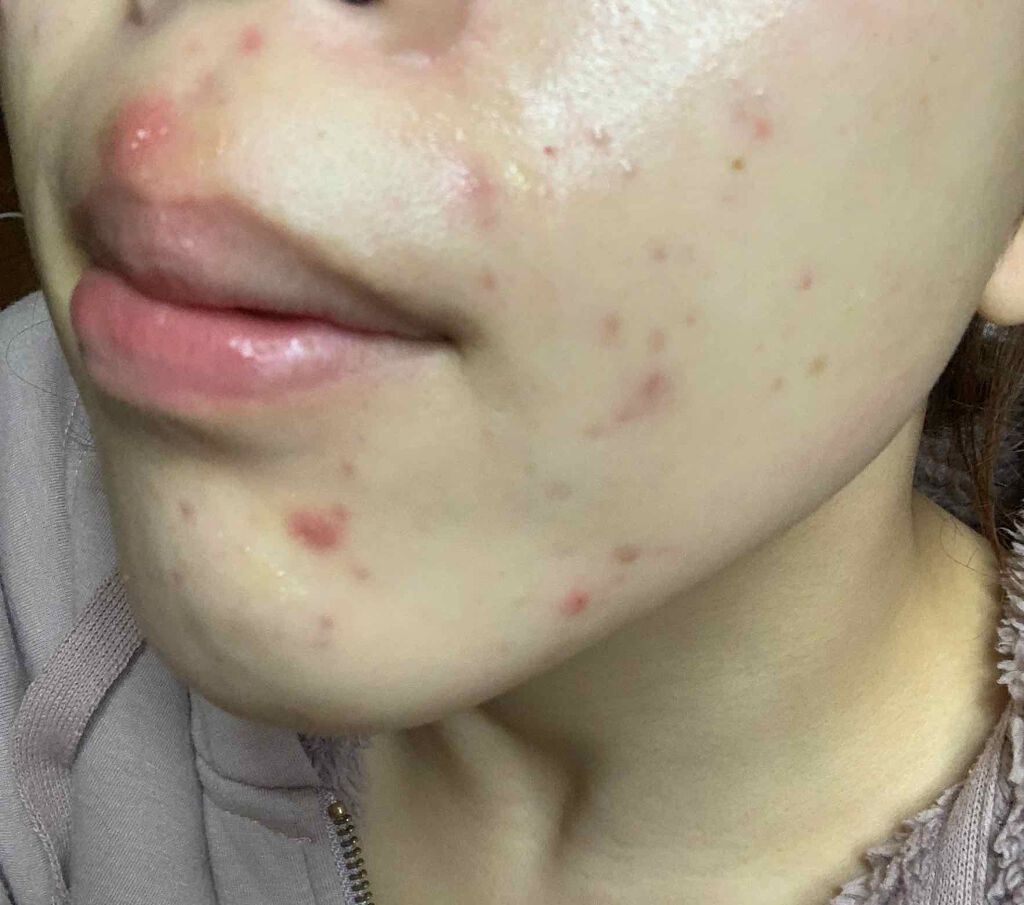 a on LIPS 「初投稿です!私は去年の11月ごろから突然大量の大人ニキビが発生..」(1枚目)