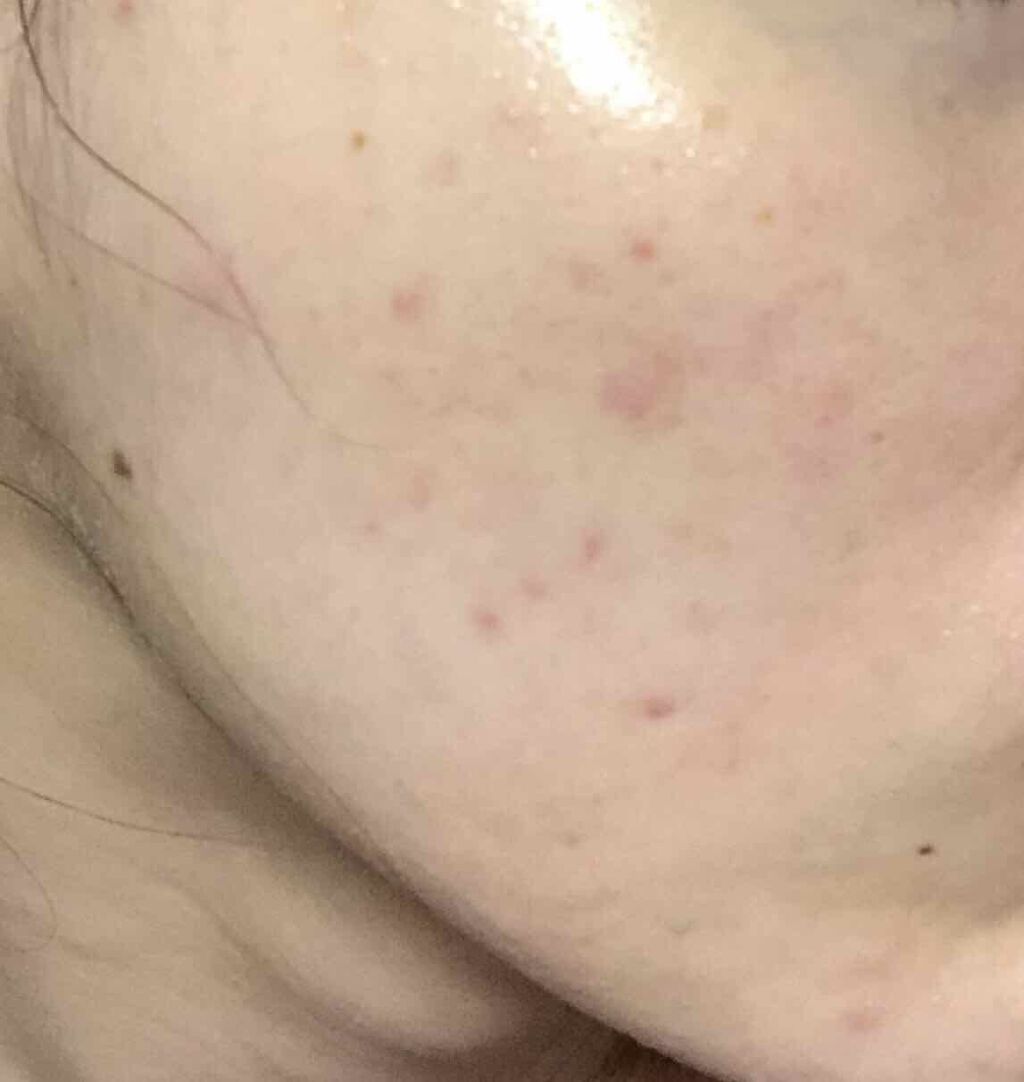 エリー⭐︎ 乾燥敏感肌 フォロバ100 on LIPS 「ニキビ経過おそらく生理からの大人ニキビが去年10月ぐらいからひ..」(2枚目)