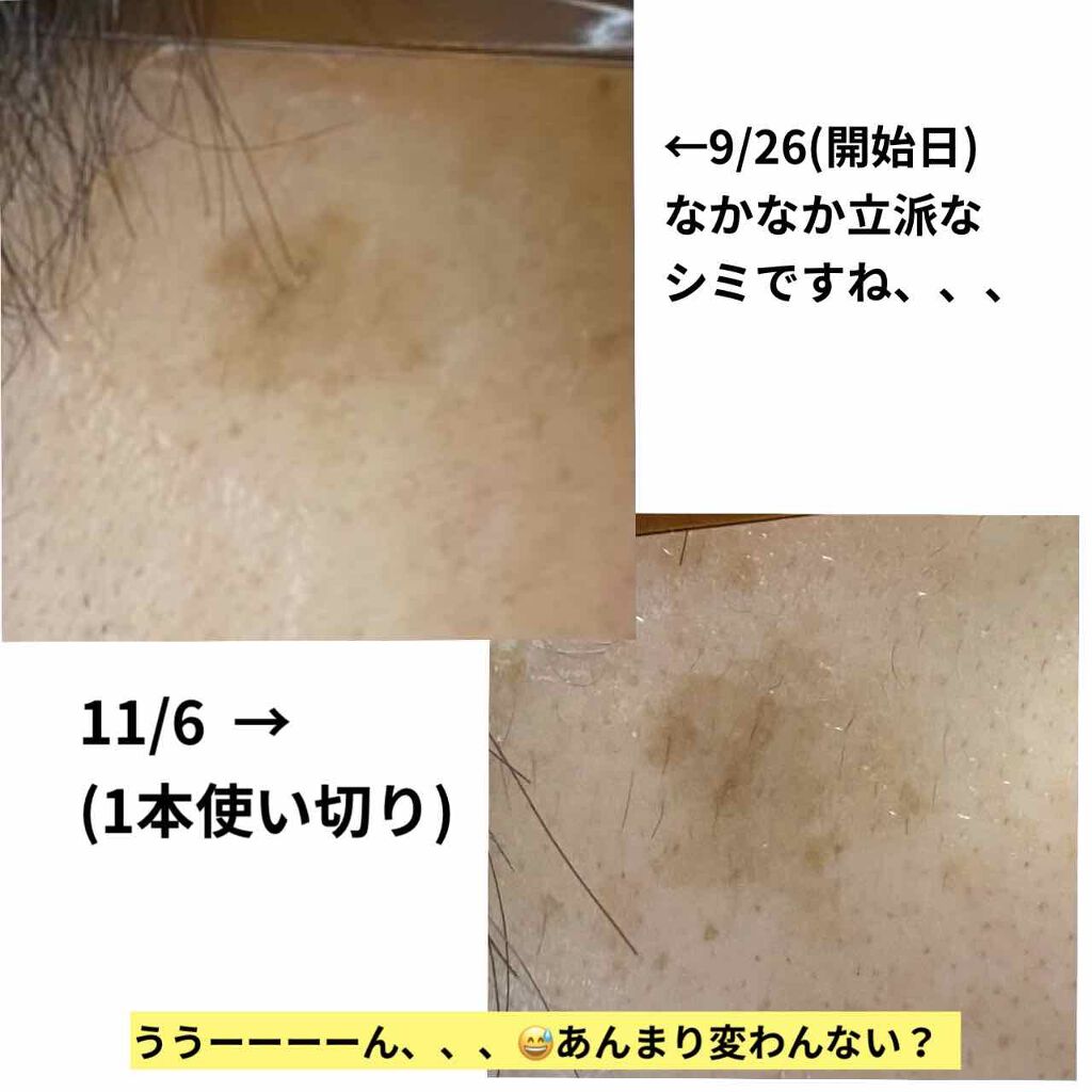 ホワイトショット  SXS/ホワイトショット/美容液を使ったクチコミ（2枚目）