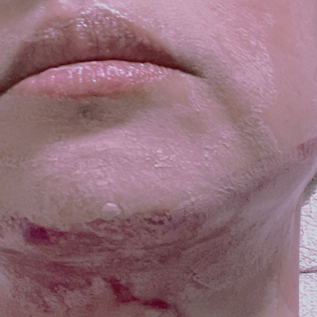 AHA 30% + BHA 2% Peeling Solution/The Ordinary/ピーリングを使ったクチコミ（1枚目）