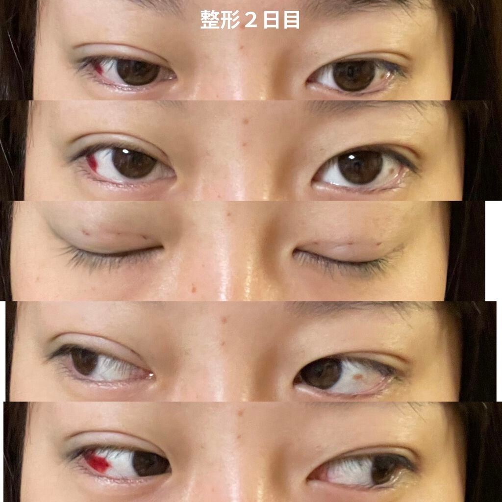 なつ on LIPS 「二重整形(埋没)しました整形記録1閲覧注意2日目〜 右目眼球内..」(3枚目)