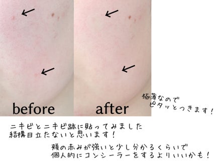クリアパッチ/Angelab/にきびパッチを使ったクチコミ(4枚目)