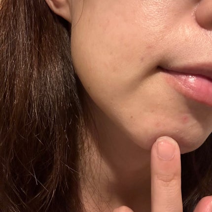 極薄透明パッチ nikipa!/金冠堂/にきびパッチを使ったクチコミ(4枚目)