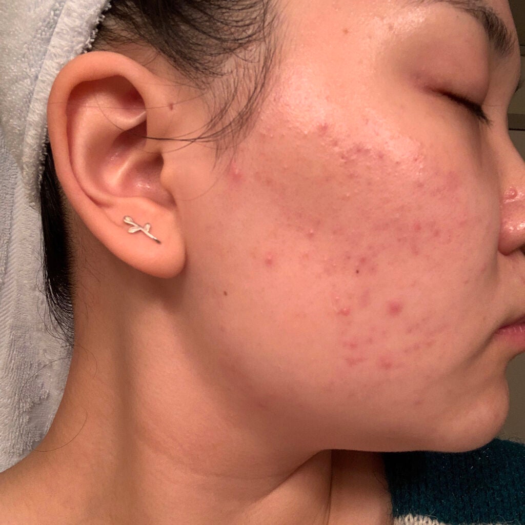 ティーツリーケア ソリューション エッセンシャルマスクEX/MEDIHEAL/シートマスク・パックを使ったクチコミ(2枚目)