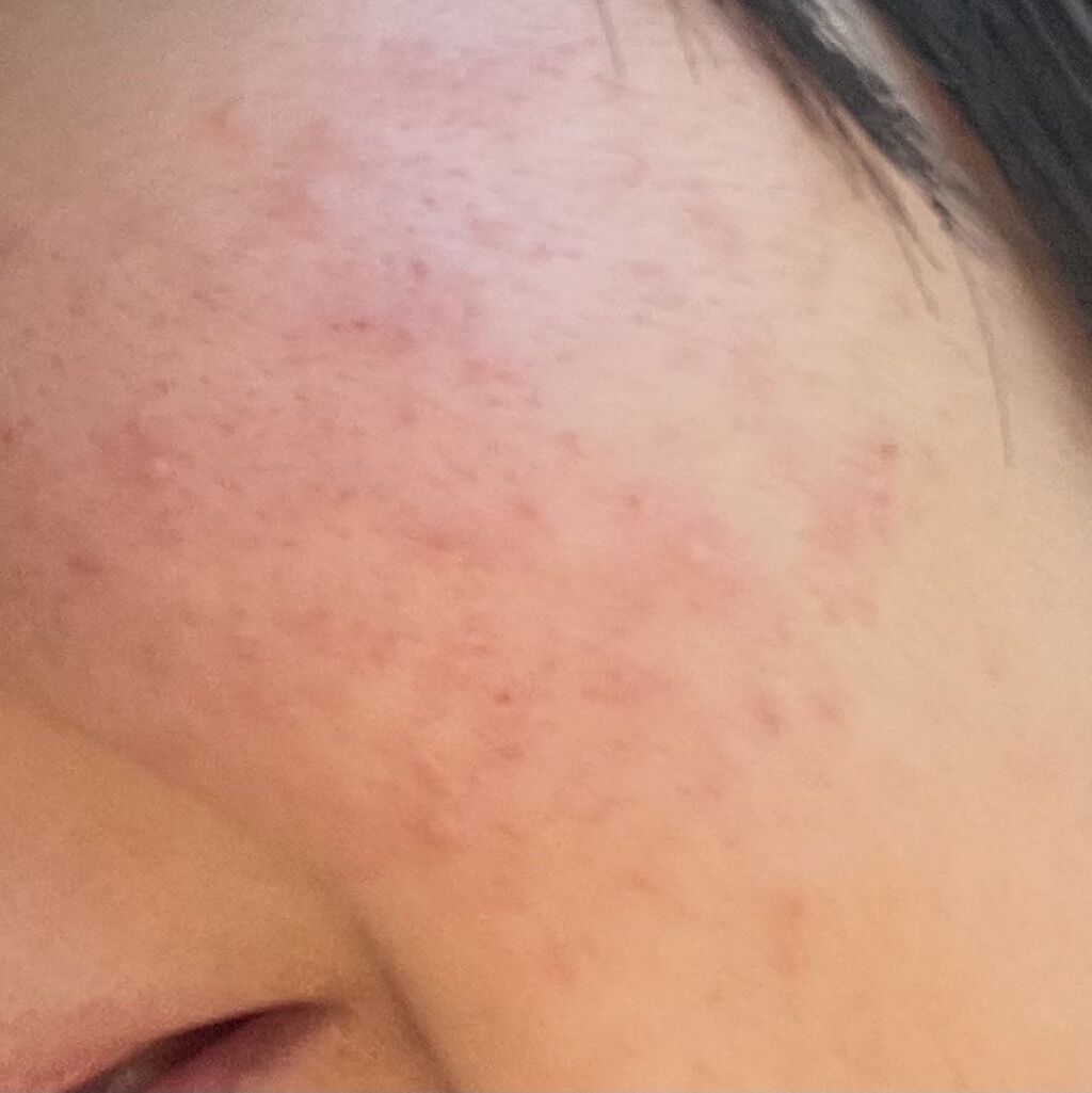 薬用 しみ 集中対策 美容液/メラノCC/美容液を使ったクチコミ（2枚目）