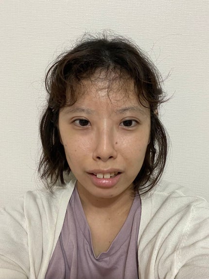 しおり on LIPS 「埋没3回目😭埋没が取れてしまったので昨日、やり直しました前は湘..」(4枚目)