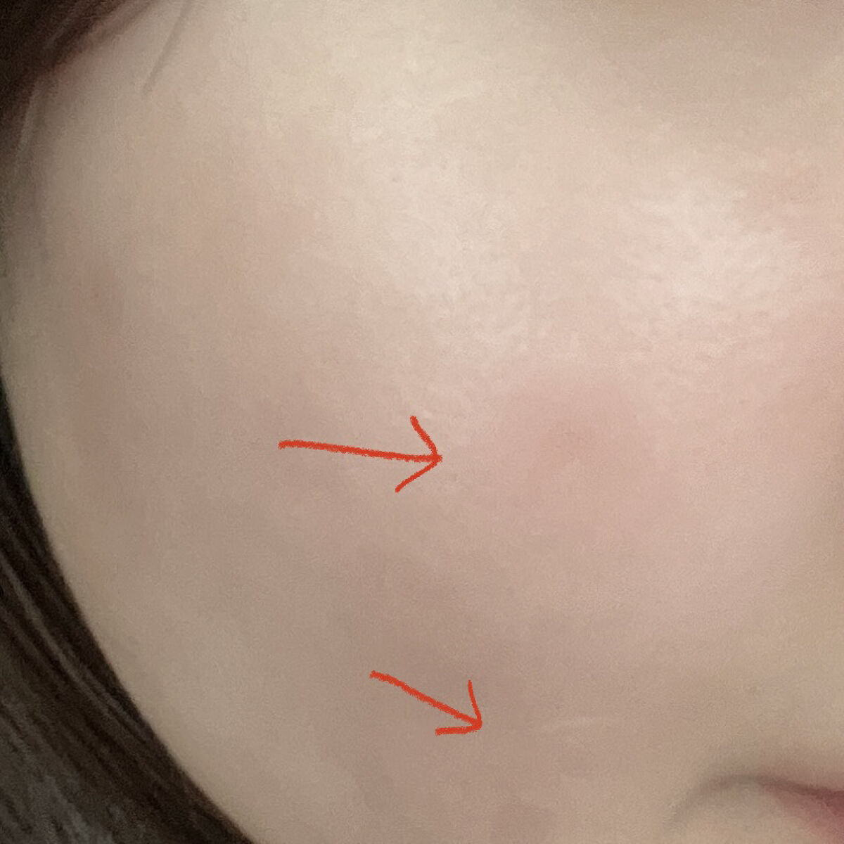 ティーツリーカーミングスポットパッチ/MEDIHEAL/その他スキンケアを使ったクチコミ（2枚目）