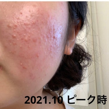 ちひろ on LIPS 「ニキビ日記最近悩んでるニキビがやっと落ち着いてきたので報告です..」（3枚目）