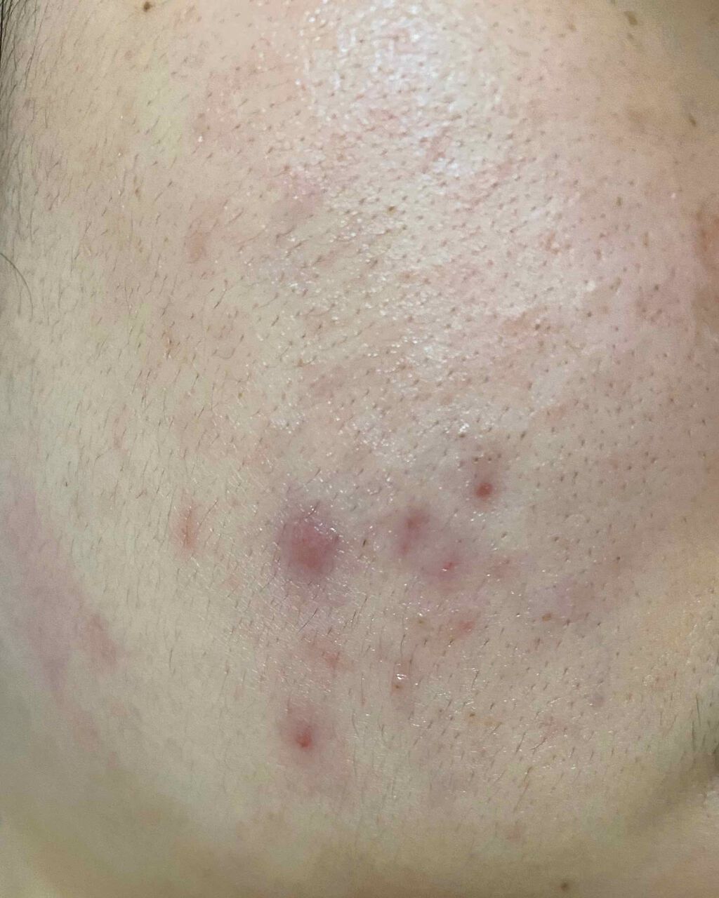 ACC パッチ/ETUDE/シートマスク・パックを使ったクチコミ（2枚目）