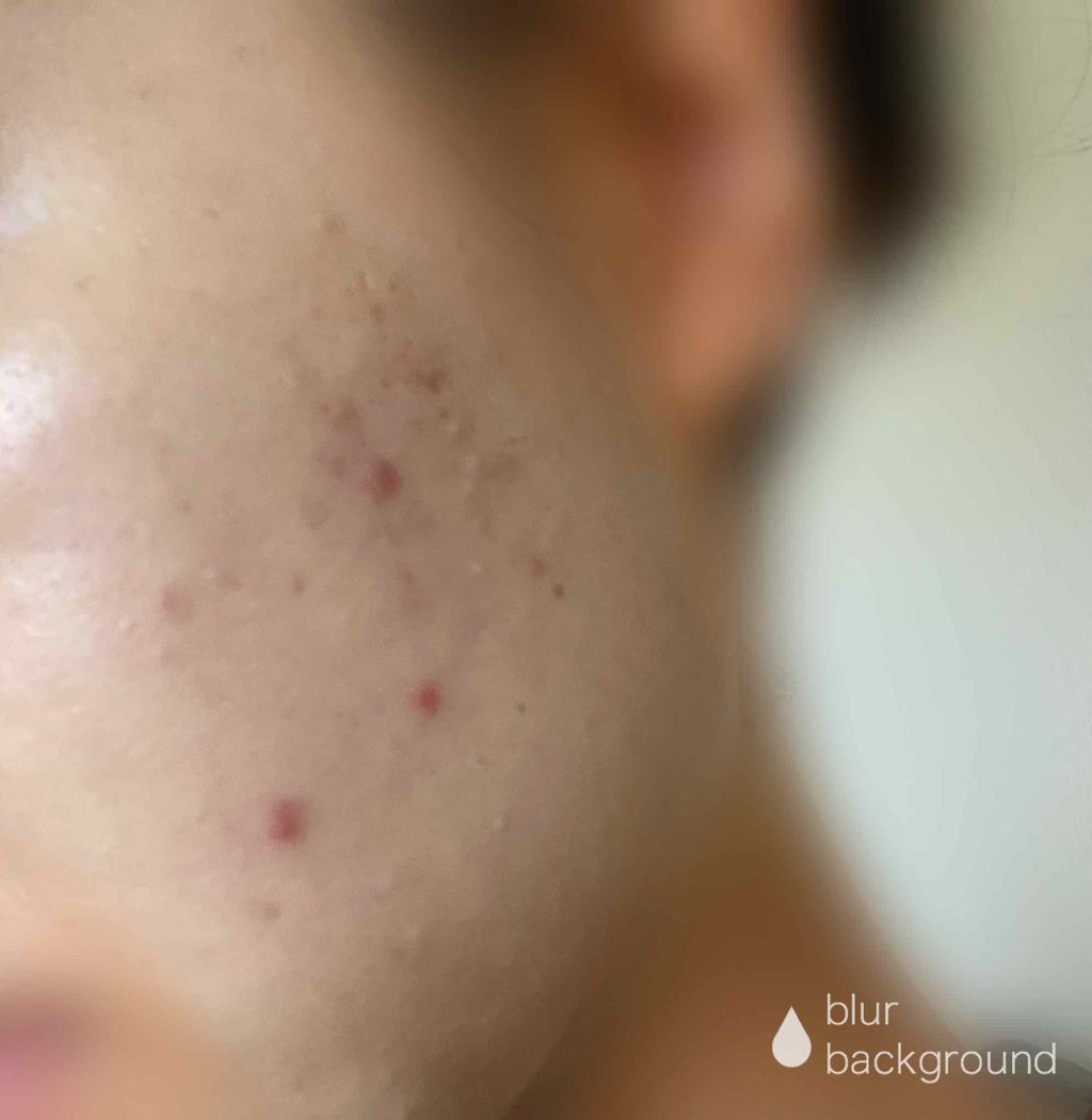 ミノン アミノモイスト 薬用アクネケア ローション/ミノン/化粧水を使ったクチコミ（2枚目）