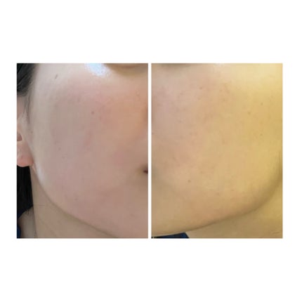 ぽむ on LIPS 「2023.9.13皮膚科に受診 エピデュオとヘパリン処方1枚目..」(5枚目)