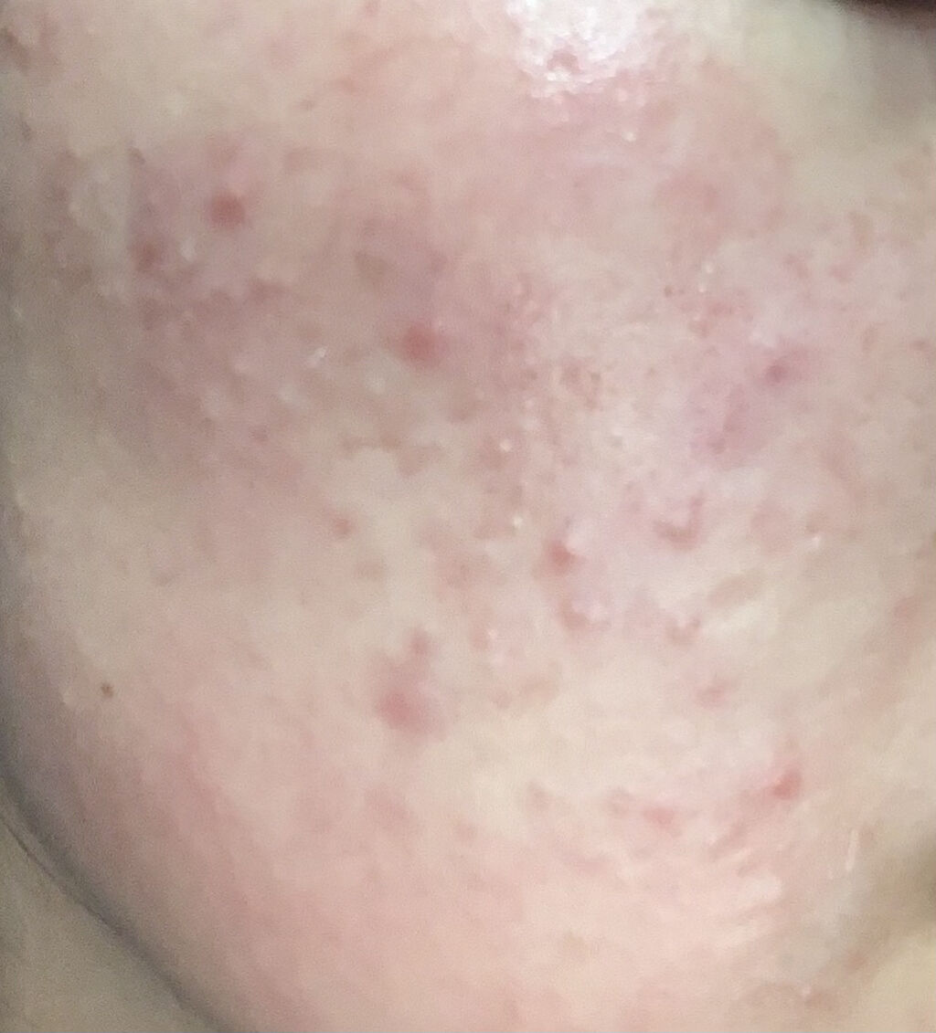 A アクネフォーム/NOV/洗顔フォームを使ったクチコミ（2枚目）