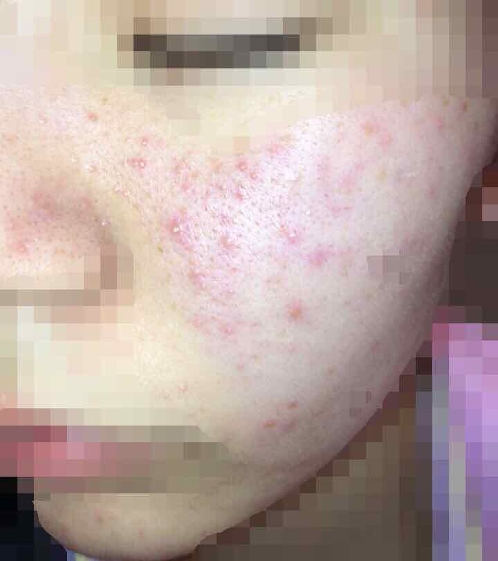 ハトムギ化粧水(ナチュリエ スキンコンディショナー R )/ナチュリエ/化粧水を使ったクチコミ（3枚目）