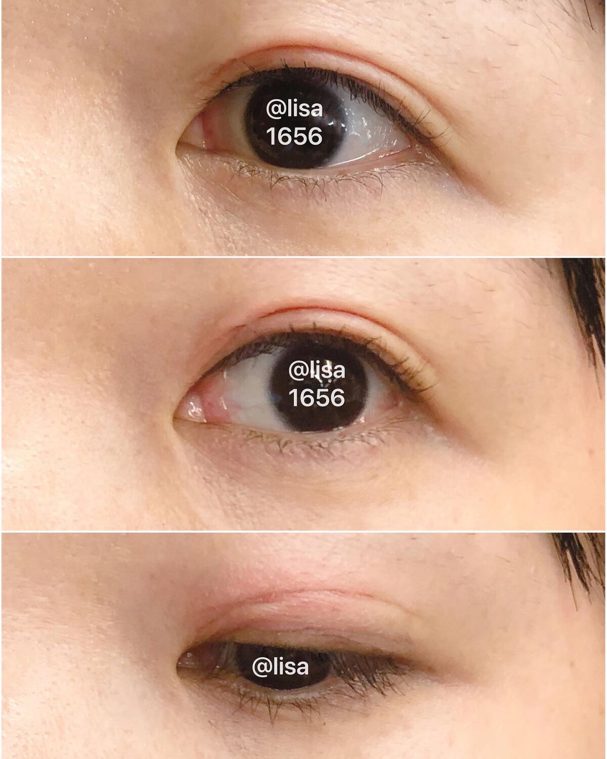 湘南美容アイリッドグルー/湘南美容/二重まぶた用アイテムを使ったクチコミ(5枚目)