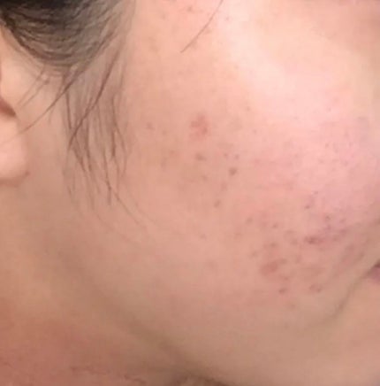 ロゼット洗顔パスタ アクネクリア/ロゼット/洗顔フォームを使ったクチコミ(4枚目)